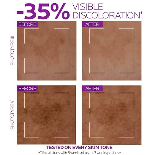la roche posay la roche posay niacinamide 10 face serum, brightening and anti aging facial serum with 10% niacinamide, reduces the look of dark spots, discoloration, and uneven skin tone